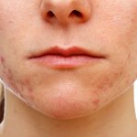 Image of Girl Suffering Acne - Acne Herbal Medications