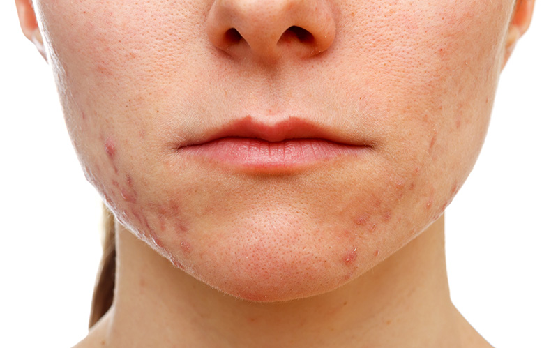 Image of Girl Suffering Acne - Acne Herbal Medications